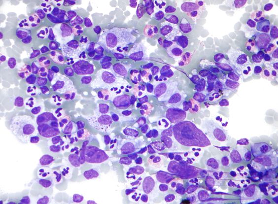 Hodgkin Lymphoma: Symptoms, Diagnosis, Causes and Treatment